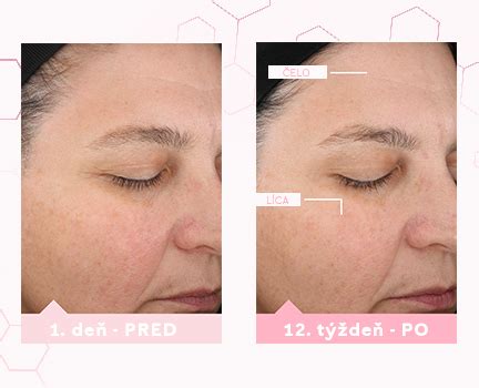 Porovnanie stavu pleti pred a po liečbe hormonálnou antikoncepciou