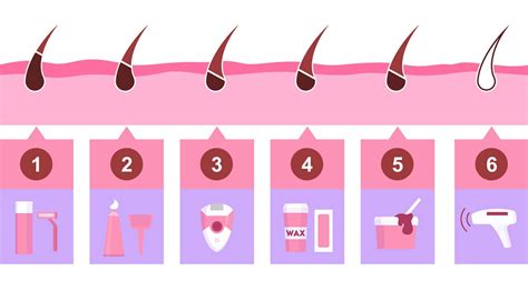 Infografika: Pre koho je IPL epilácia vhodná
