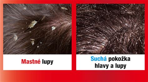 Rôzne typy vlasov a pokožky hlavy (mastné, suché, poškodené, citlivé) v infografike