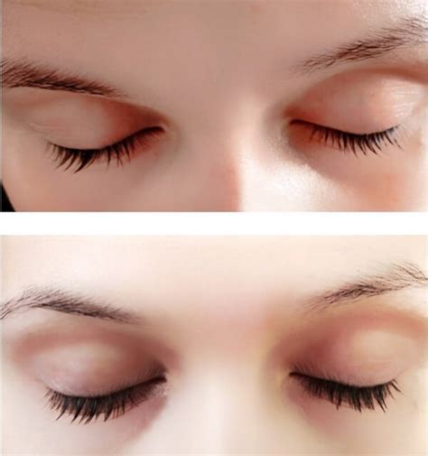 Porovnanie rias pred a po použití séra