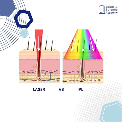 rozdiel_ipl_laser