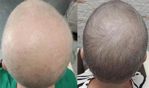 Proces rastu vlasov po chemoterapii