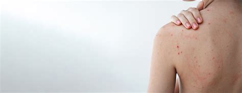 Dôvody pre odstraňovanie ochlpenia na chrbte