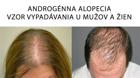 Typické vzory vypadávania vlasov u mužov a žien
