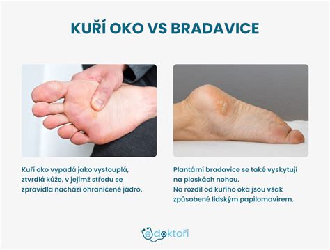 Ilustrácia plantárnej bradavice na chodidle s viditeľnými čiernymi bodkami