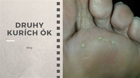 Detail kurieho oka na prste nohy