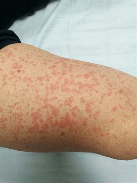 Alergická reakcia na tetovanie hennou na koži