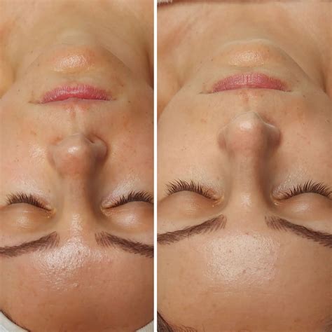 ukážka výsledkov pred a po IPL ošetrení