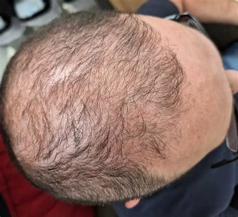 Riešenia bežných problémov s vlasmi u mužov