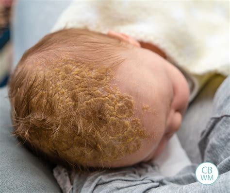 Dojča s mliečnou chrastou (cradle cap)