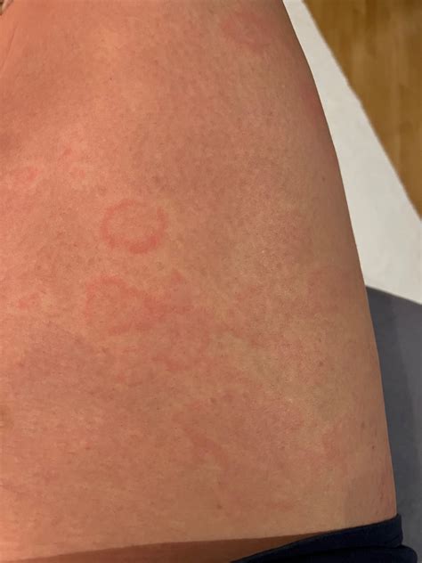 Porovnanie typov podráždenia po holení: červené pupienky a červené fľaky