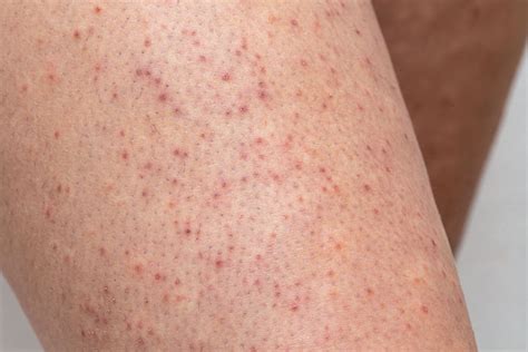 Hĺbková versus povrchová folikulitída