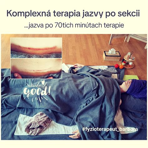 Správna hygiena pri starostlivosti o jazvu po cisárskom reze