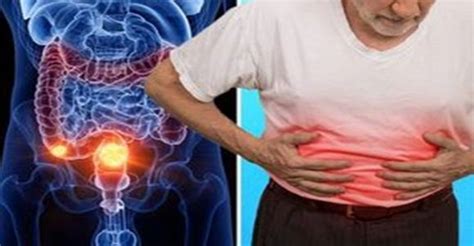 Ilustrácia pupienkov pri folikulitíde