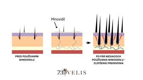 Porovnanie zdravých vlasov a rednúcich vlasových folikulov