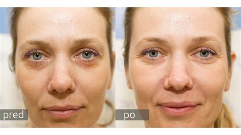 Príprava oblasti očí pred aplikáciou farby